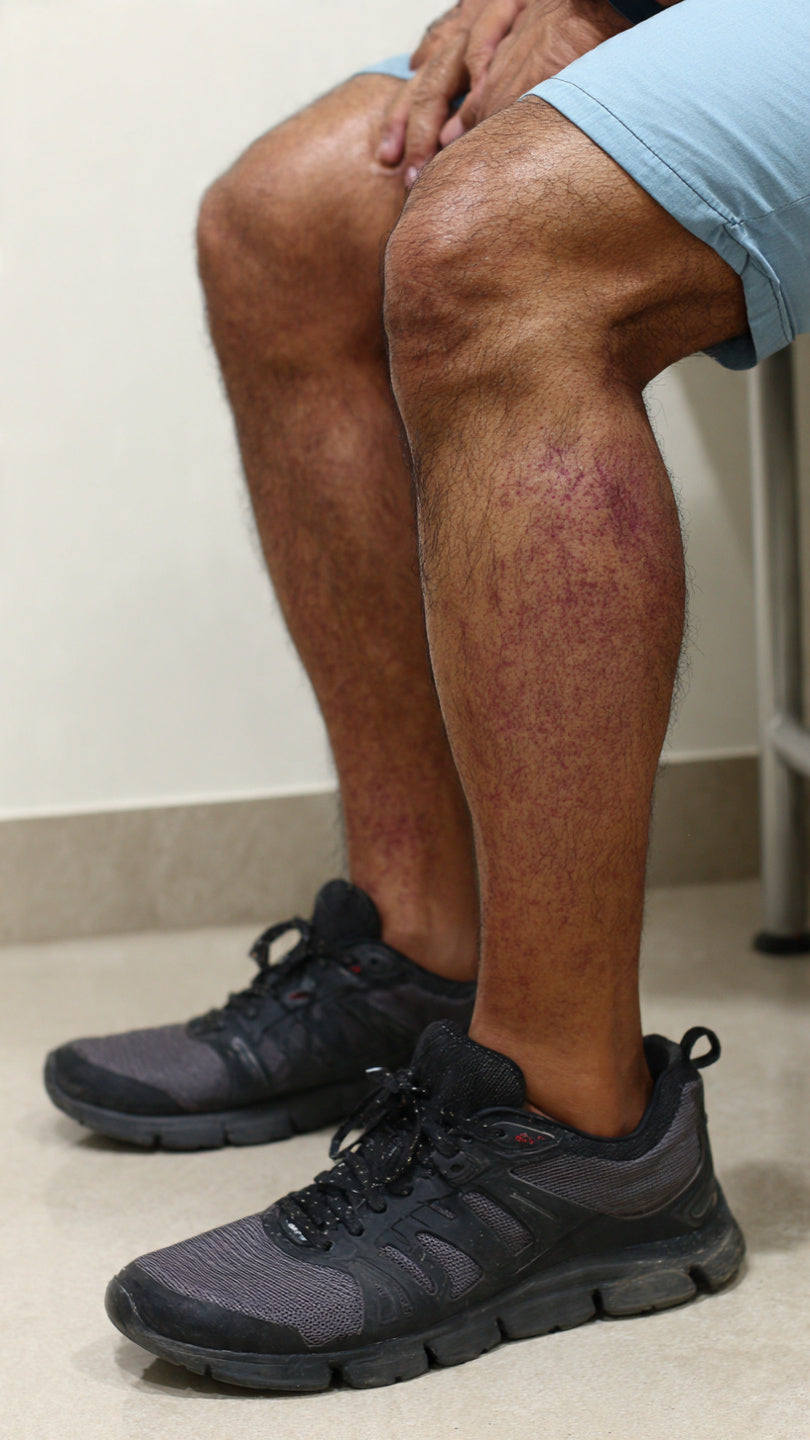 Edema: Causes, Symptoms, Diagnosis and Ayurvedic Herbal Remedies for Fluid Retention