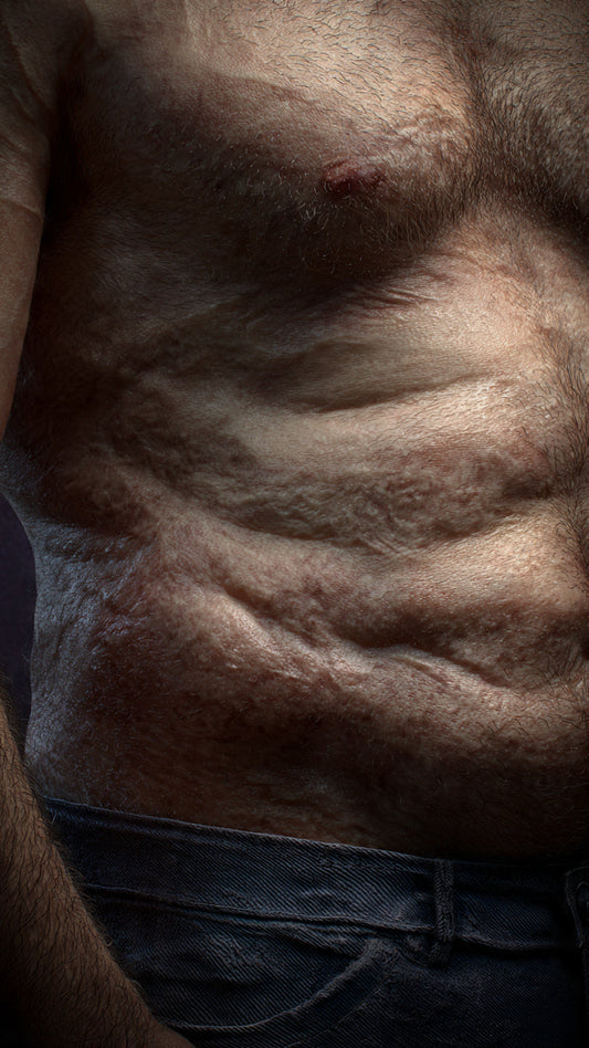 Ascites (Jalodara): Understanding Abdominal Fluid Accumulation and Its Ayurvedic Management